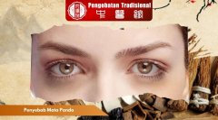 Penyebab Mata Panda dan Cara Mengatasinya Secara Alami