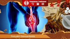 Cara Mengatasi Penyakit Osteoarthritis Lutut dengan Alami