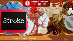 Mari Mengetahui Gejala Awal Stroke Bagian Kanan
