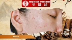 Rosacea pada Wajah: Pemicu dan Solusi Perawatannya