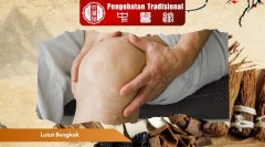 Mengenal Berbagai Penyebab Lutut Bengkak dan Pencegahannya