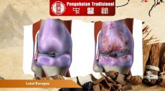 Penyebab Lutut Keropos dan yang Perlu Diwaspadai dan Solusin