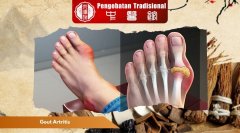 Gout Artritis: Penyakit yang Mengancam Kesehatan Sendi