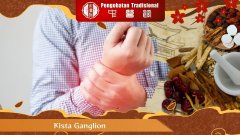 Apakah Kista Ganglion Berbahaya? Ini Penjelasannya
