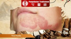Tinea Fasialis: Gejala, Penyebab, dan Cara Mencegahnya