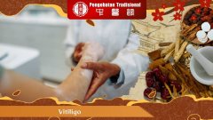 Vitiligo Bukan Penyakit Menular! Ini Penjelasannya