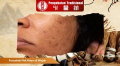 Penyebab Flek Hitam di Wajah yang Sering Diabaikan