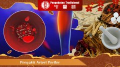 Dampak Penyakit Arteri Perifer dan Cara Mengatasinya