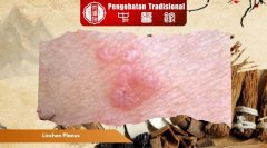 Linchen Planus: Gangguan Kulit yang Perlu Diwaspadai