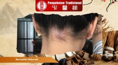 Dermatitis Seboroik Kambuh? Lakukan ini untuk Mengendalikann