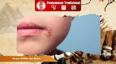 5 Penyebab Herpes di Bibir dan Mulut yang Perlu Diketahui