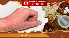 Eksim: Penyakit Kulit Sepele atau Tanda Bahaya yang Terabaik