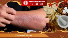 Kulit Gatal Terus? Ini 7 Penyebab Eksim yang Sering Terabaik