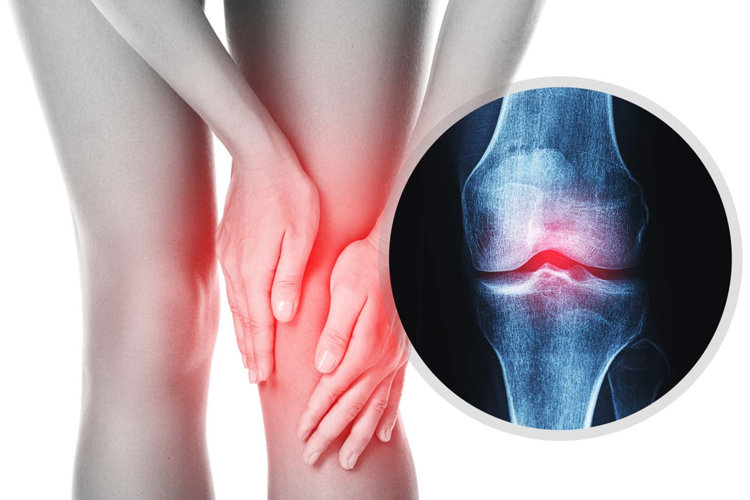 Osteoartritis